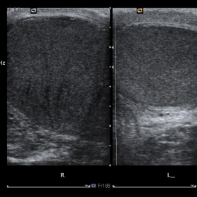 Ultrasound (Transverse Section - Dual)
