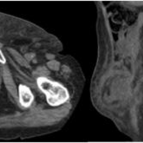 Axial and sagital non-enhanced CT of the inguinal mass