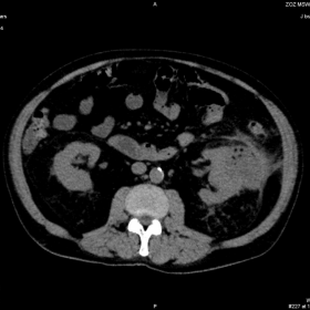 Non-contrast CT images