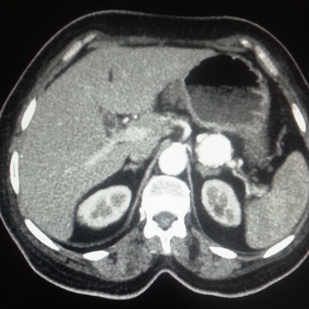 CT abdomen