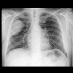 PA and lateral view of chest X-ray