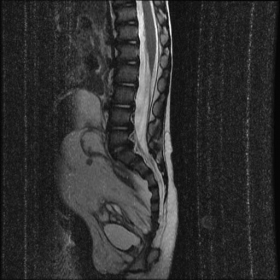 MRI - T2 images