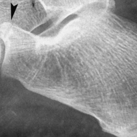 Lateral radiograph of left foot