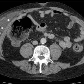 Hypodense collection in the right anterolateral abdominal wall and rectus