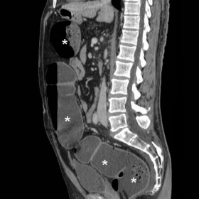 Water-enema multidetector CT colonography - initial acquisition