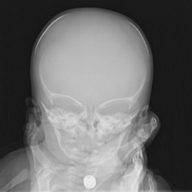 Frontal skull radiograph