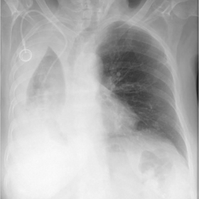 PA chest X-ray