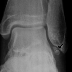 Ankle radiograph