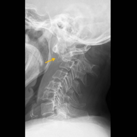 Lateral cervical spine radiography