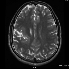 MRI - T2 axial images