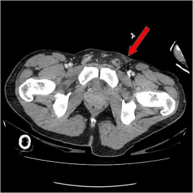 CT image of pelvis