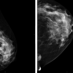 Follow-up mammogram
