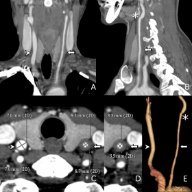 CT angiography with multiplanar and VR reconstructions