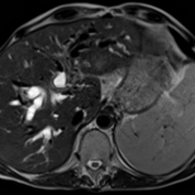MRI of the liver (Dec-2014)