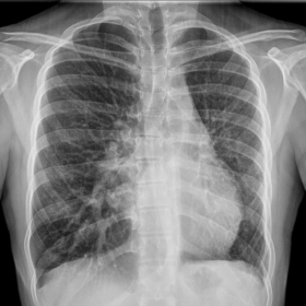 Chest radiography
