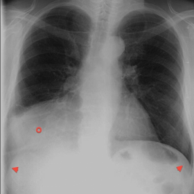 PA chest radiography