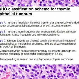 Classification of thymoma