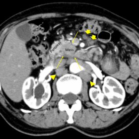 Abdominal CT, axial image, arterial phase