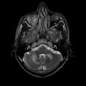 MRI - T2 images