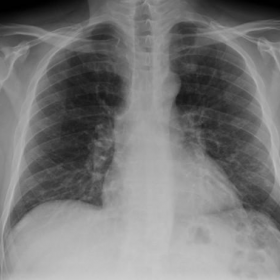 Initial postero-anterior and latero-lateral chest radiographs