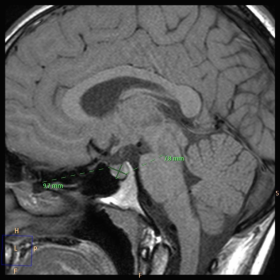 Pituitary MRI