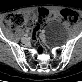 Contrast-enhance CT of the pelvis