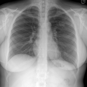 Initial PA chest X-ray