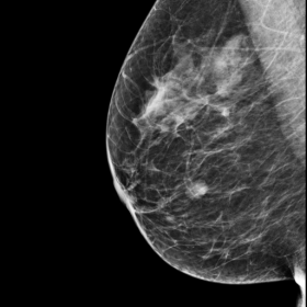 Right Mammogram Oblique View