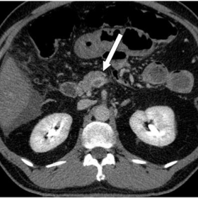 Axial contrast enhanced abdominal multidetector CT image.