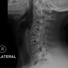 Plain radiograph cervical spine