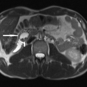 Axial T2-weighted HASTE image