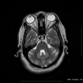 Axial T2W MRI