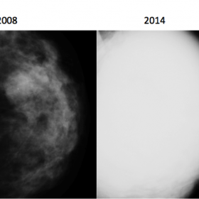 Mammography comparison 2008/2014
