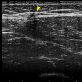 Grey scale ultrasound with a high frequency transducer