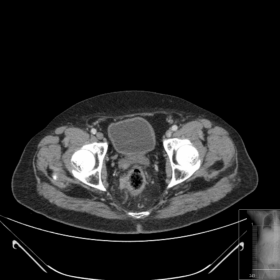 Staging CT for rectal carcinoma