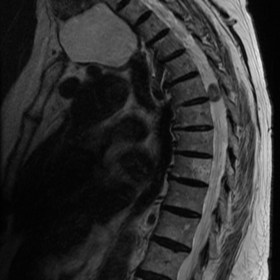 MRI T2 sagittal