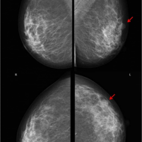 Bilateral mammogram with heterogeneously dense parenchyma (ACR – c)