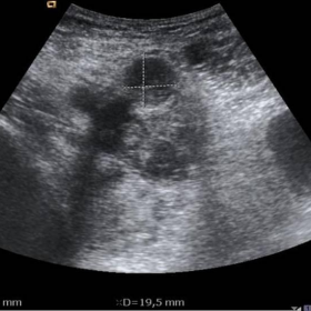 Grey-scale and colour Doppler US of the right groin