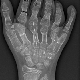 Plain radiography of the right hand