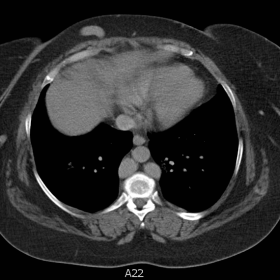 CT abdomen and pelvis