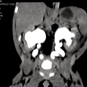 CT image of kidneys, bladder and urethra