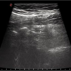Abdominal ultrasound of the right lower quadrant
