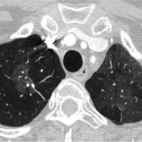 Axial multi-detector-CT (MDCT) image of the chest at parenchymal window