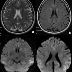 Axial T2, FLAIR and diffusion-weighted images of the brain