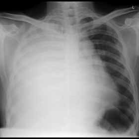 Chest PA radiograph initial and follow-up