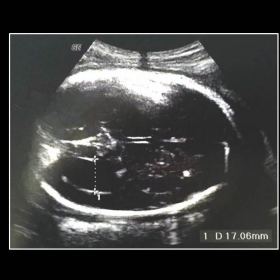 Second trimester obstetric US