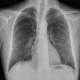 Screening standard chest radiographs obtained before  anti-TNFα therapy start