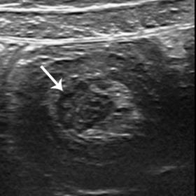Ultrasound findings of the abdomen