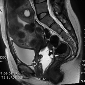 Pelvic MRI sagittal T2