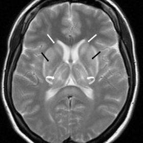 MRI brain